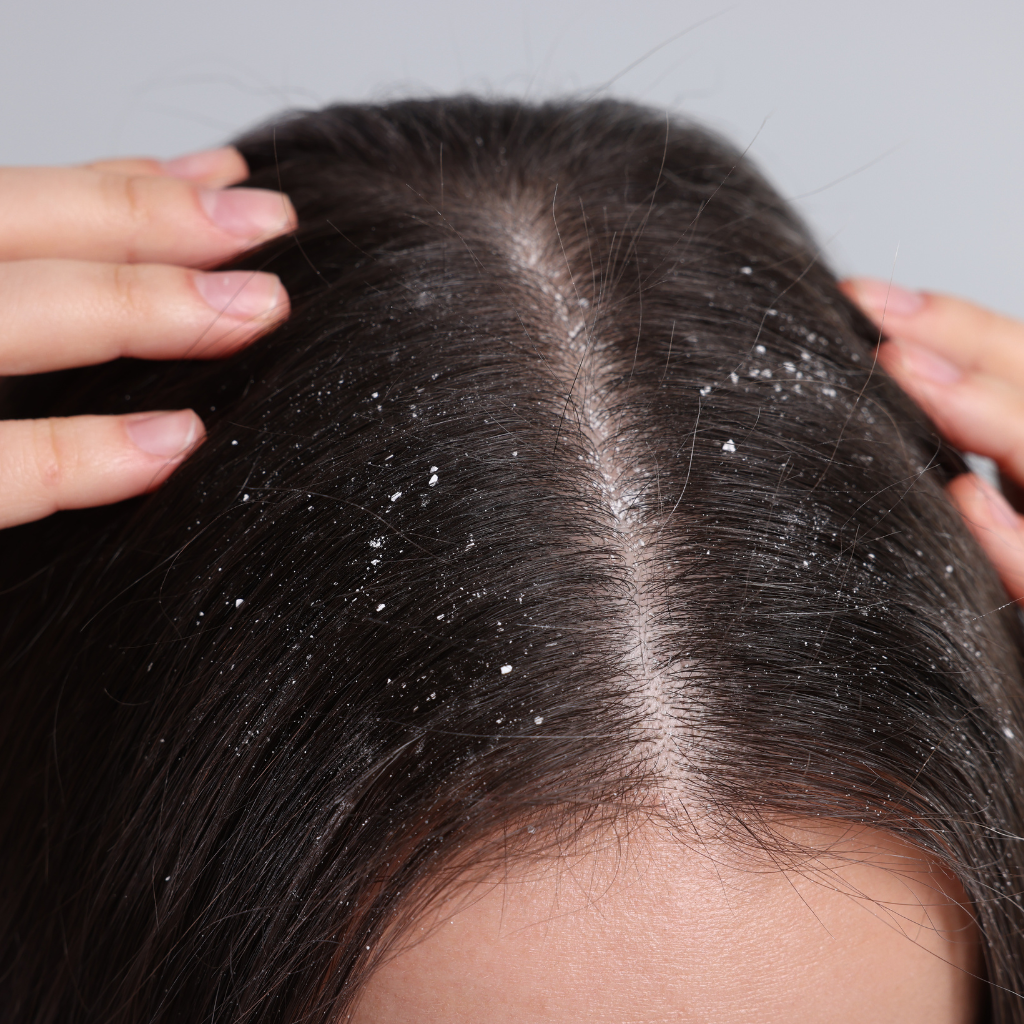 how to decrease hair fall and dandruff
