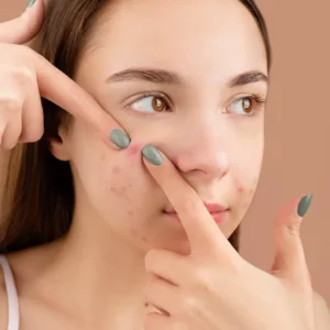 difference between cyst and pimple